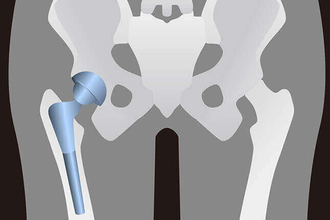 人工関節・関節鏡の手術
